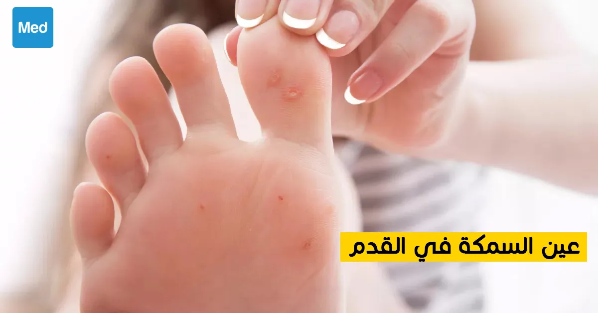 عين السمكة في القدم